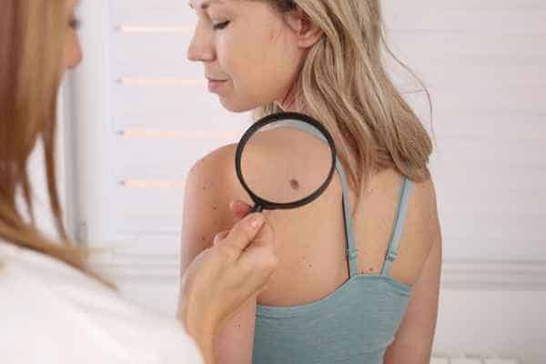 What Are Traditional Skin Lesion Removal Methods Warrington?