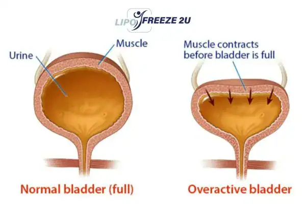 diagram of overactive bladder treatment Warrington