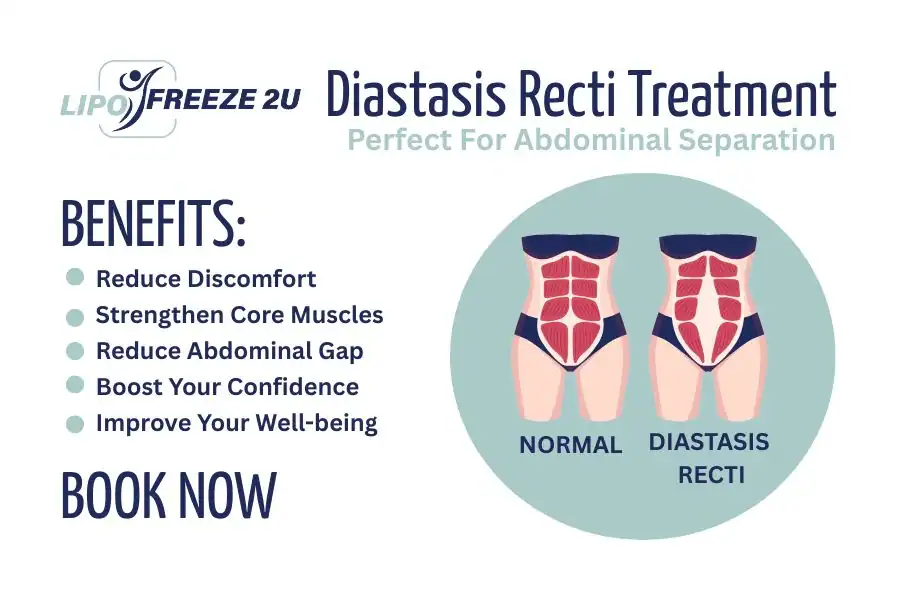 How Long Will It Take to See Improvements in Diastasis Recti Warrington