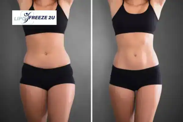 How Can LIPO FREEZE 2U Support Your Post-Pregnancy Body Recovery Warrington?