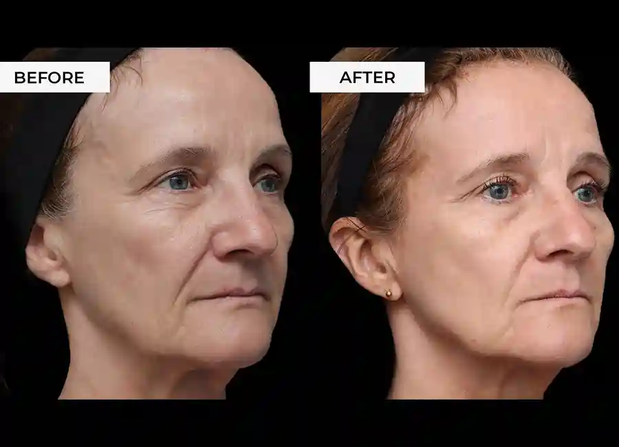 How Many RF Microneedling Sessions Will You Need to See a Difference Warrington?