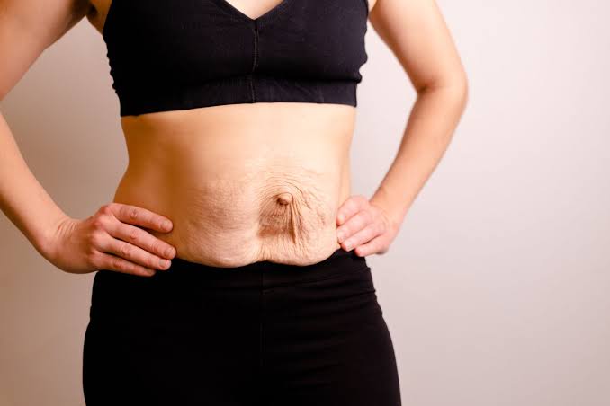 Is Surgery Really the Only Way to Repair Diastasis Recti Warrington?