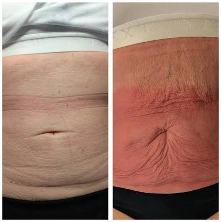 How Does RF Microneedling Improve Crepey, Thin and Uneven Skin Texture Warrington?