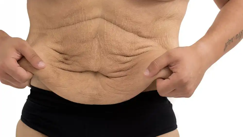Why Does Weight Loss Medication Leave Some People With Loose or Sagging Skin Warrington?